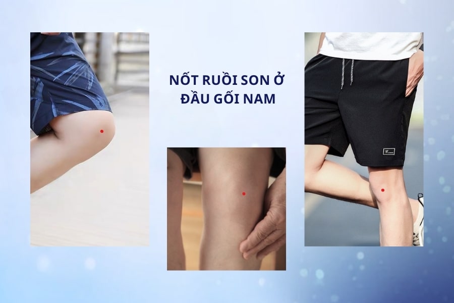 Luận nốt ruồi ở đầu gối : tướng số giàu sang hay nghèo hèn