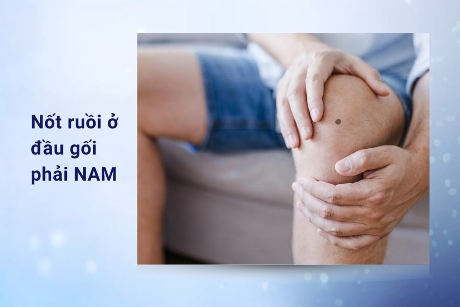 Luận nốt ruồi ở đầu gối : tướng số giàu sang hay nghèo hèn