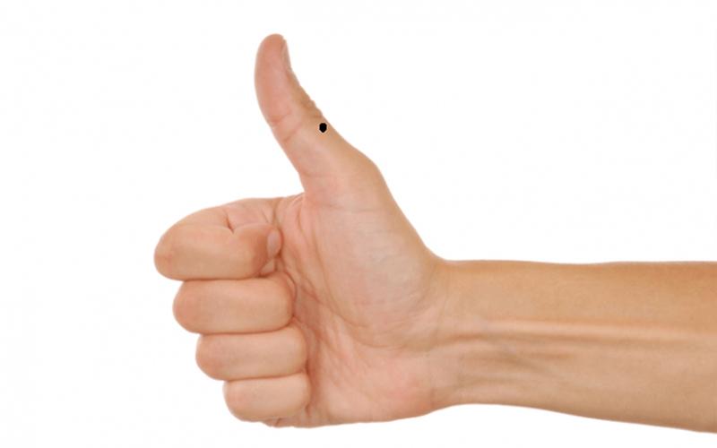 Nốt ruồi son ở ngón tay cái bên phải